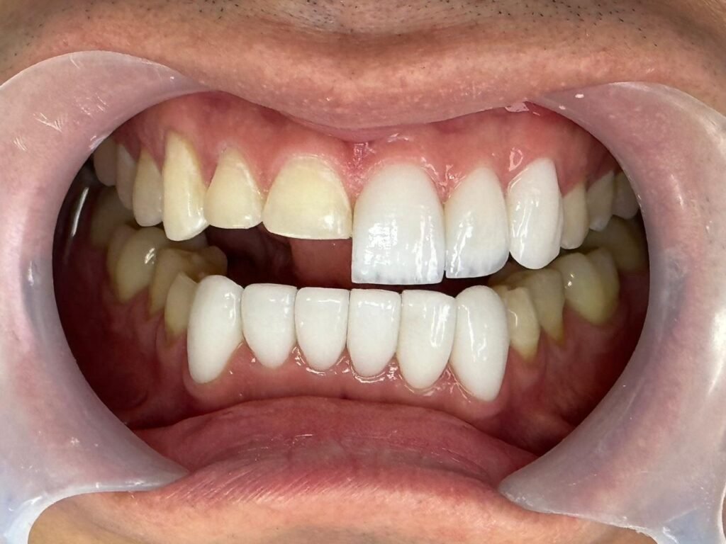 endodoncia-en-medellin